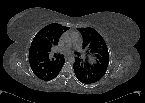 Chondrosarcoma - chest wall (Radiopaedia 65192-74199 Axial bone window 57).jpg