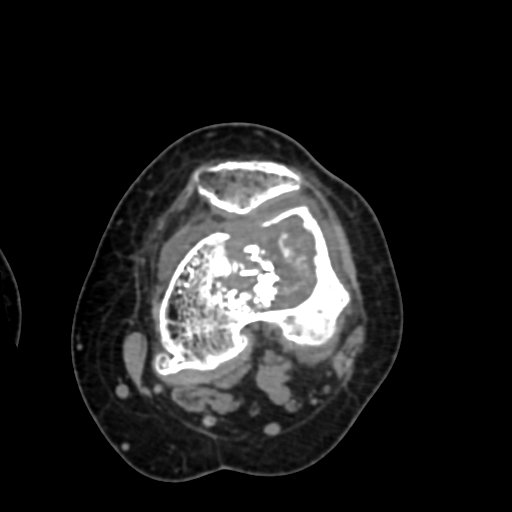 Chondrosarcoma - femur (Radiopaedia 64187-72954 Axial non-contrast 42).jpg