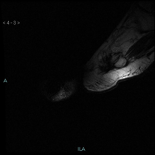 File:Chondrosarcoma - phalanx (Radiopaedia 69047-78813 Sagittal T2 3).jpg