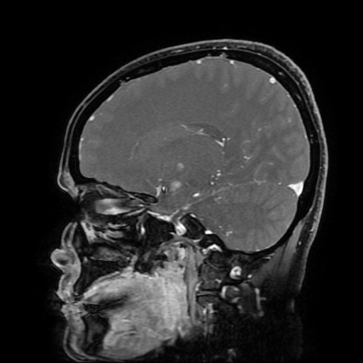 File:Chordoid glioma of third ventricle (Radiopaedia 91612-109340 F 87).jpg