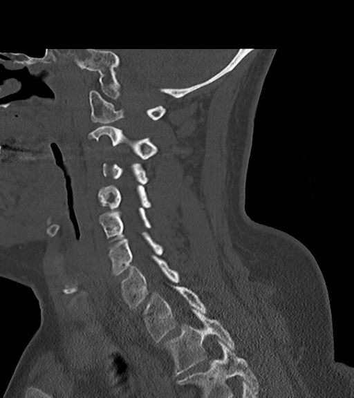 File:Chordoma (C4 vertebra) (Radiopaedia 47561-52188 Sagittal bone window 32).png