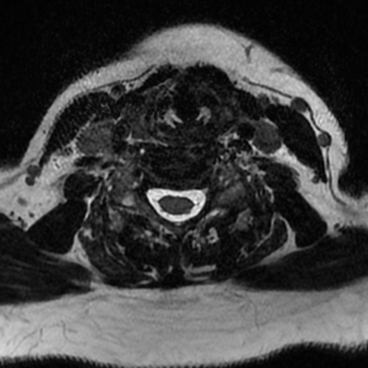 Chordoma - cervical spine (Radiopaedia 70084-80111 Axial T2 59).png