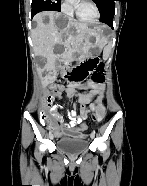 Choriocarcinoma liver metastases (Radiopaedia 74768-85766 B 41).jpg