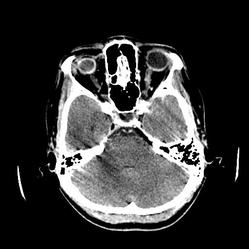 File:Choriocarcinoma of ovary with cerebral and pulmonary metastases (Radiopaedia 25983-26118 C+ arterial phase 41).jpg