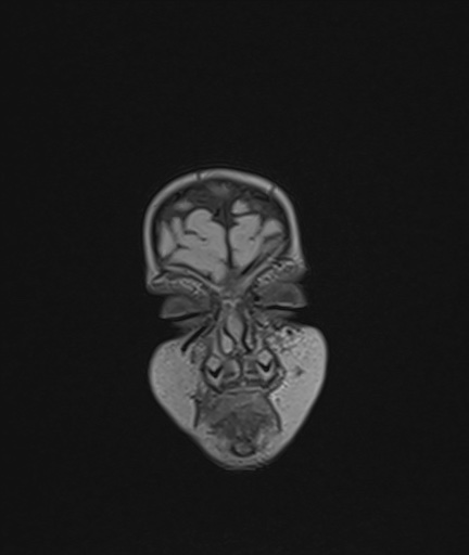 Choroid plexus papilloma (Radiopaedia 84612-100019 Coronal FLAIR 4).jpg