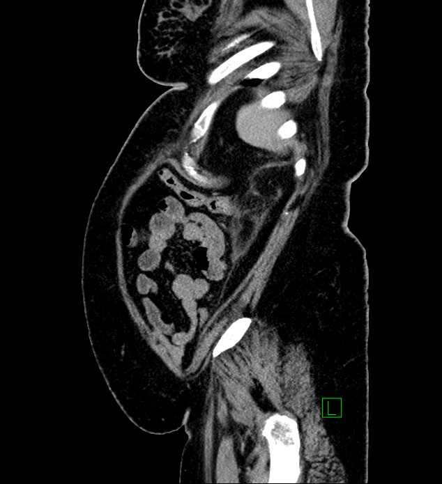 Chromophobe renal cell carcinoma (Radiopaedia 84239-99519 G 20).jpg