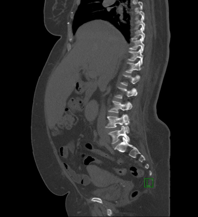 Chromophobe renal cell carcinoma (Radiopaedia 84239-99519 Sagittal bone window 64).jpg