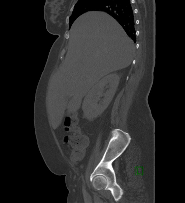 Chromophobe renal cell carcinoma (Radiopaedia 84239-99519 Sagittal bone window 79).jpg