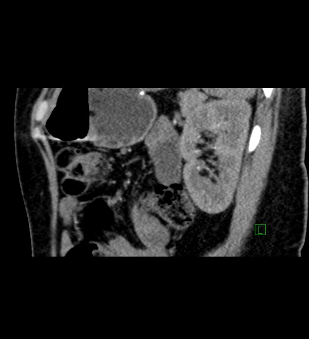Chromophobe renal cell carcinoma (Radiopaedia 84290-99582 D 27).jpg