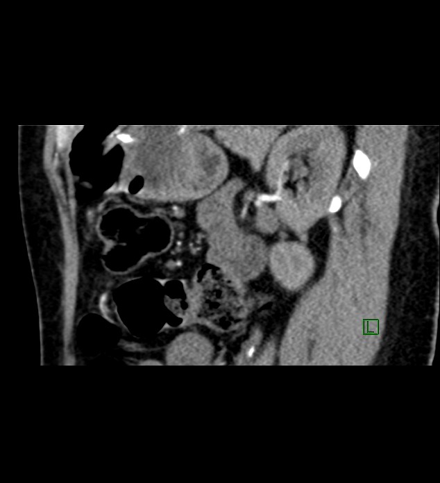 Chromophobe renal cell carcinoma (Radiopaedia 84290-99582 D 33).jpg