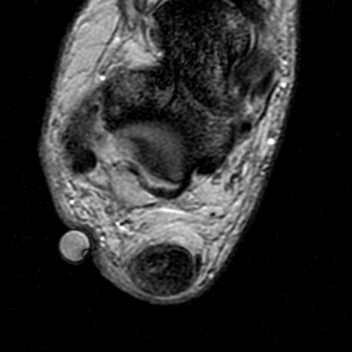 File:Chronic Achilles tendon rupture (Radiopaedia 15262-15100 Axial Gradient Echo 17).jpg