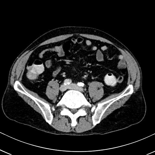 Chronic appendicitis complicated by appendicular abscess, pylephlebitis and liver abscess (Radiopaedia 54483-60700 B 100).jpg