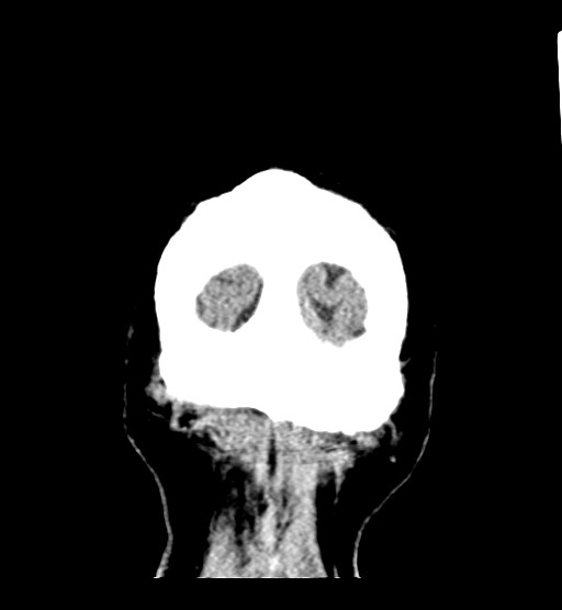 Chronic bilateral subdural hygroma (Radiopaedia 85801-101623 B 11).jpg