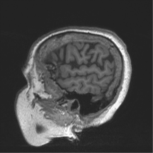 Chronic hypertensive encephalopathy (Radiopaedia 39993-42482 Sagittal T1 78).png