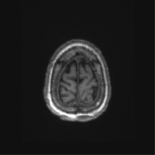 Chronic hypertensive encephalopathy (Radiopaedia 72844-83495 Axial T1 8).png