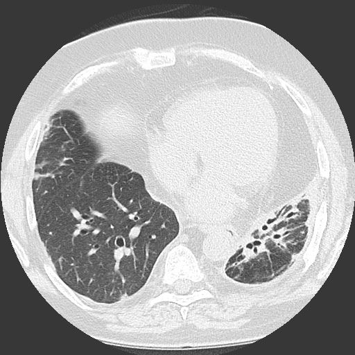 Chronic lung allograft dysfunction - restrictive form (Radiopaedia 60595-68316 Axial lung window 47).jpg