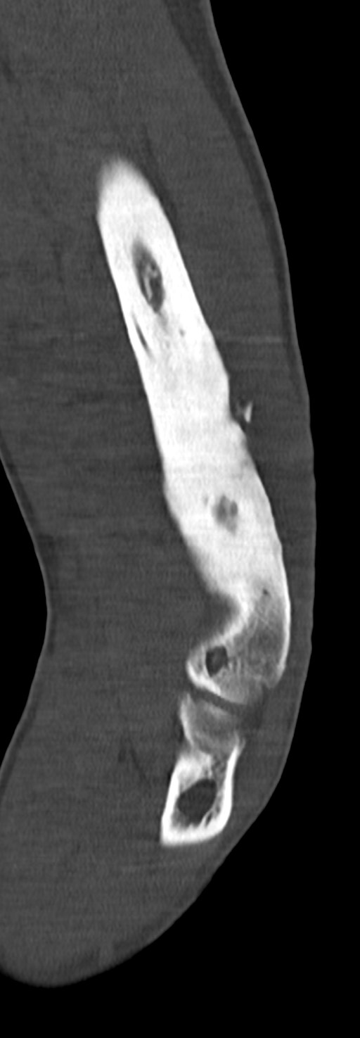 Chronic osteomyelitis of the distal humerus (Radiopaedia 78351-90971 Sagittal bone window 48).jpg