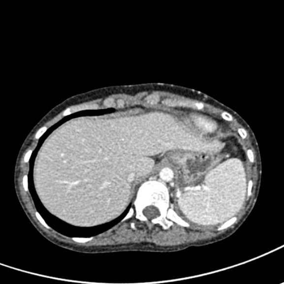 File:Chronic pancreatitis (Radiopaedia 55405-61846 A 18).jpg