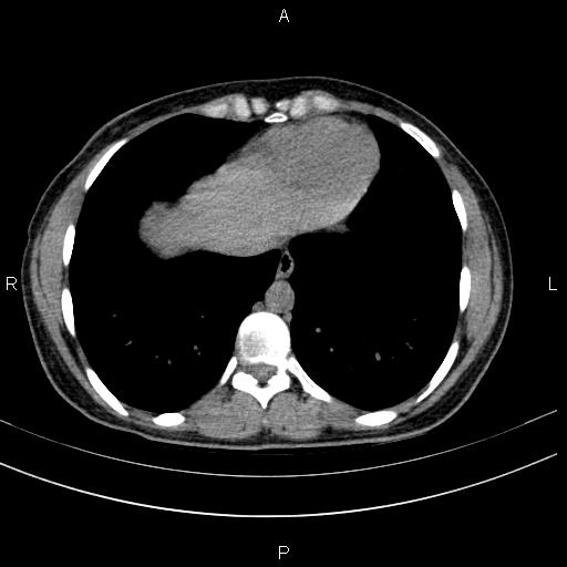 Chronic pancreatitis (Radiopaedia 64576-73450 Axial non-contrast 2).jpg