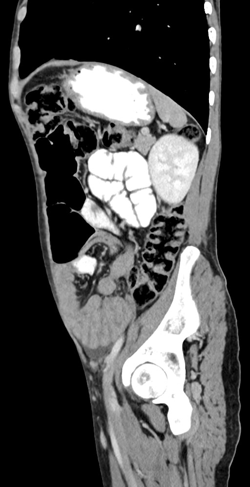 Chronic small bowel volvulus (Radiopaedia 75224-86322 C 44).jpg
