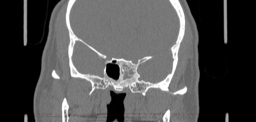 File:Chronic sphenoidal sinusitis (Radiopaedia 62030-70122 Coronal bone window 115).jpg