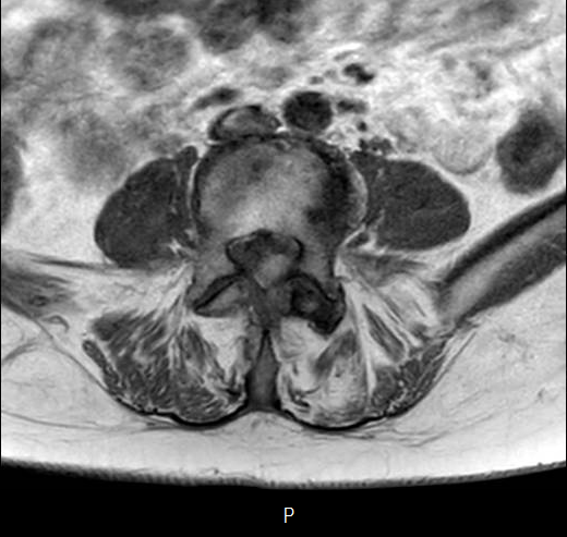 File:Chronic spinal hematoma with cauda equina syndrome (Radiopaedia 75745-87090 Axial T1 21).png
