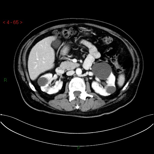 File:Circumaortic left renal vein and doubled left renal arteries (Radiopaedia 52268-58158 B 25).jpg