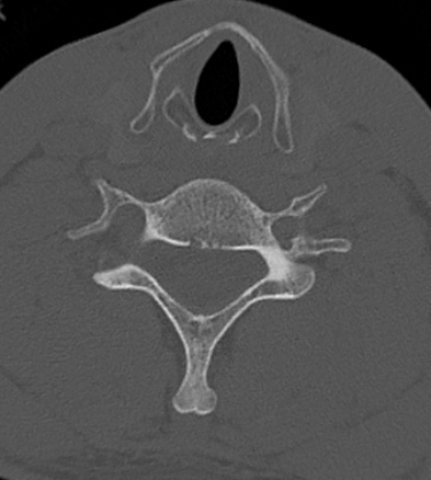Clay-shoveler fracture (Radiopaedia 14604-14532 Axial bone window 6).jpg