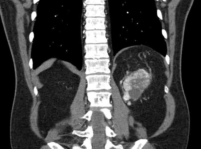 File:Clear cell renal cell carcinoma (Radiopaedia 61449-69393 C 41).jpg