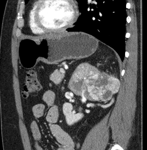 File:Clear cell renal cell carcinoma (Radiopaedia 61449-69393 D 32).jpg