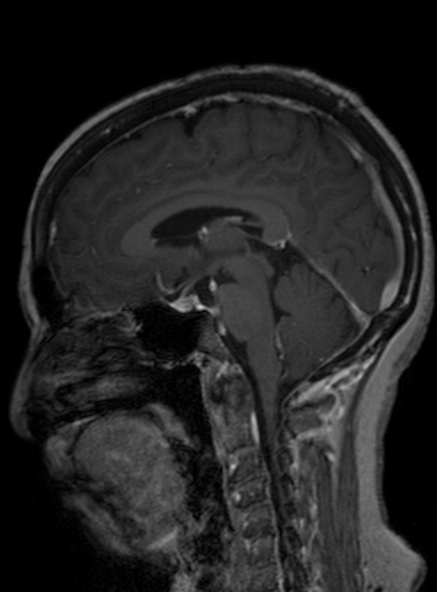 Clival meningioma (Radiopaedia 53278-59248 Sagittal T1 C+ 254).jpg