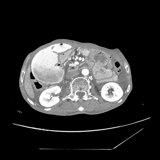 Closed-loop obstruction due to peritoneal seeding mimicking internal hernia after total gastrectomy (Radiopaedia 81897-95864 A 68).jpg