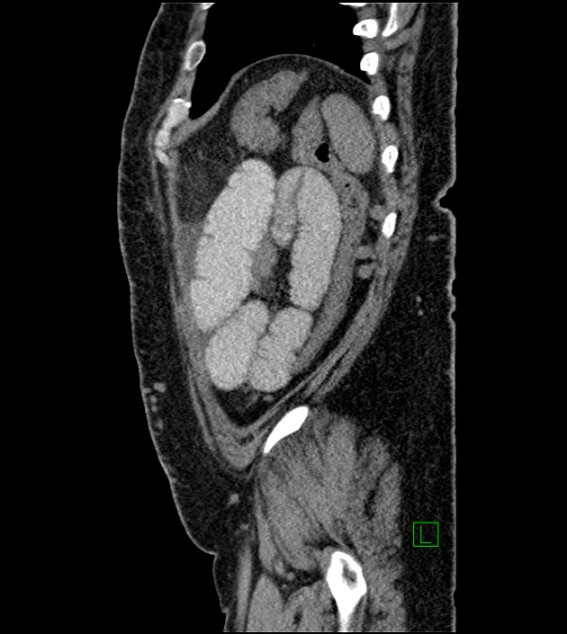 Closed-loop small bowel obstruction-internal hernia (Radiopaedia 78439-91096 C 29).jpg