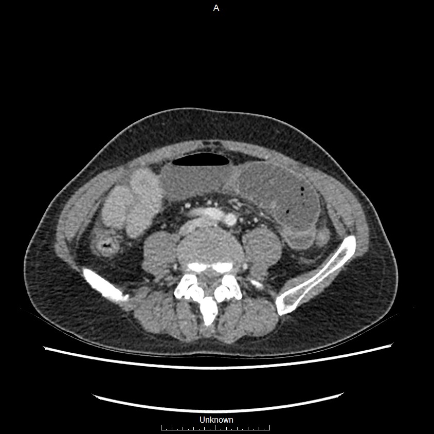 Closed loop bowel obstruction and ischemia (Radiopaedia 86959-103180 A 51).jpg