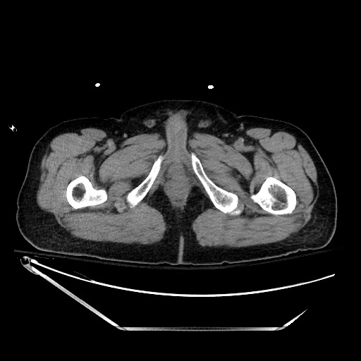 File:Closed loop obstruction due to adhesive band, resulting in small bowel ischemia and resection (Radiopaedia 83835-99023 Axial non-contrast 169).jpg