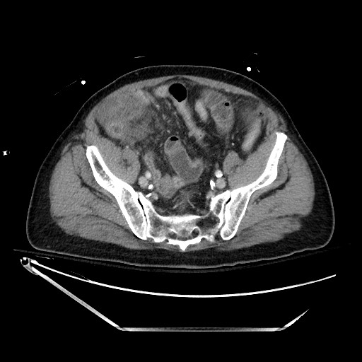File:Closed loop obstruction due to adhesive band, resulting in small bowel ischemia and resection (Radiopaedia 83835-99023 D 121).jpg