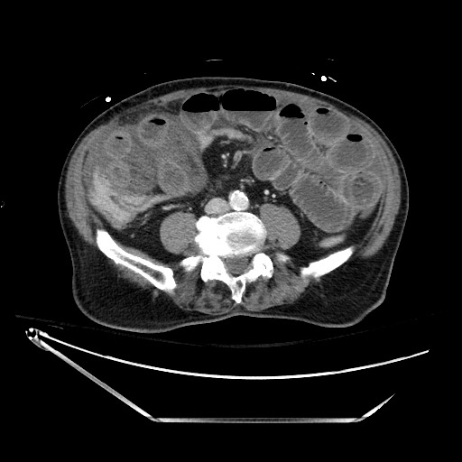 Closed loop obstruction due to adhesive band, resulting in small bowel ischemia and resection (Radiopaedia 83835-99023 D 94).jpg