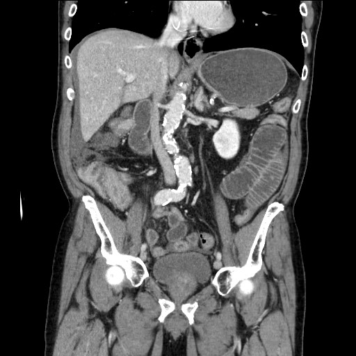 Closed loop obstruction due to adhesive band, resulting in small bowel ischemia and resection (Radiopaedia 83835-99023 E 66).jpg