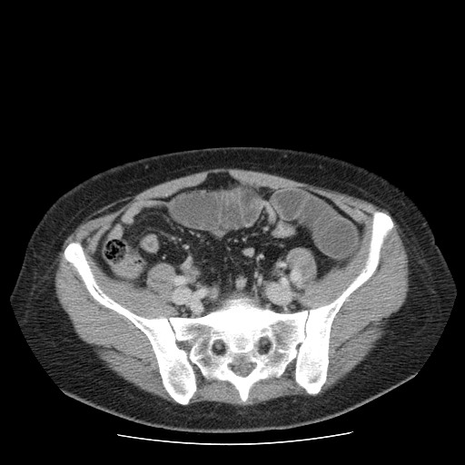 File:Closed loop small bowel obstruction (Radiopaedia 65403-74451 A 59).jpg