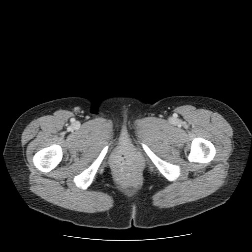 File:Closed loop small bowel obstruction (Radiopaedia 65403-74451 A 86).jpg