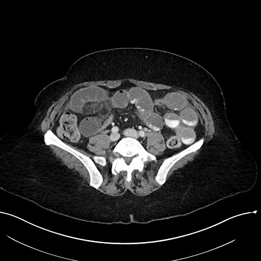 File:Closed loop small bowel obstruction - adhesions (Radiopaedia 59078-66369 A 84).jpg