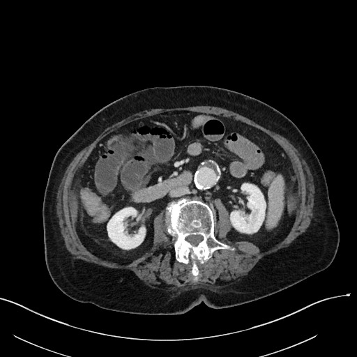 File:Closed loop small bowel obstruction - adhesions (Radiopaedia 59269-66611 A 62).jpg