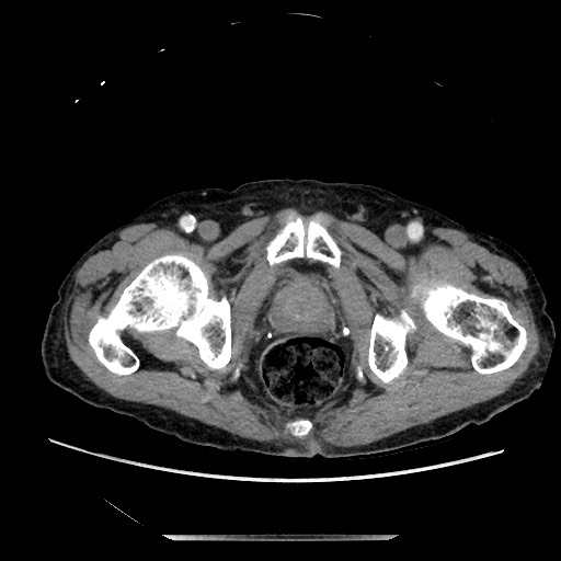 Closed loop small bowel obstruction - adhesive disease and hemorrhagic ischemia (Radiopaedia 86831-102990 A 175).jpg