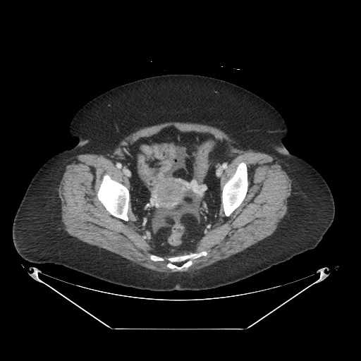 Closed loop small bowel obstruction - internal hernia (Radiopaedia 65402-74450 A 116).jpg
