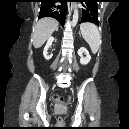 Closed loop small bowel obstruction - internal hernia (Radiopaedia 65402-74450 B 74).jpg