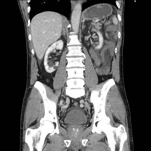 Closed loop small bowel obstruction - omental adhesion causing "internal hernia" (Radiopaedia 85129-100682 B 79).jpg