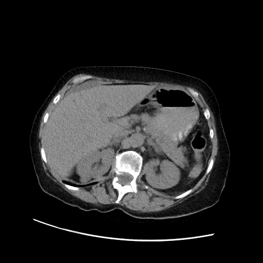 File:Closed loop small bowel obstruction due to adhesive band, with intramural hemorrhage and ischemia (Radiopaedia 83831-99017 Axial non-contrast 51).jpg