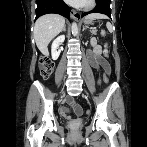 Closed loop small bowel obstruction due to adhesive bands - early and late images (Radiopaedia 83830-99015 B 74).jpg