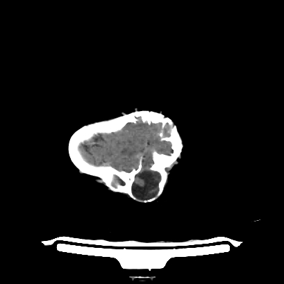 File:Cloverleaf skull (Radiopaedia 91901-109710 Axial non-contrast 133).jpg