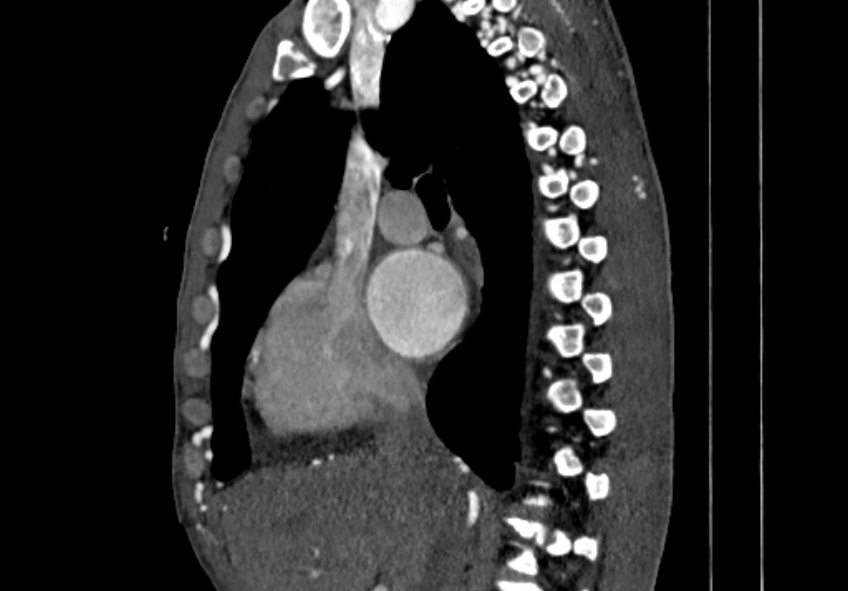 Coarctation of aorta with aortic valve stenosis (Radiopaedia 70463-80574 B 21).jpg